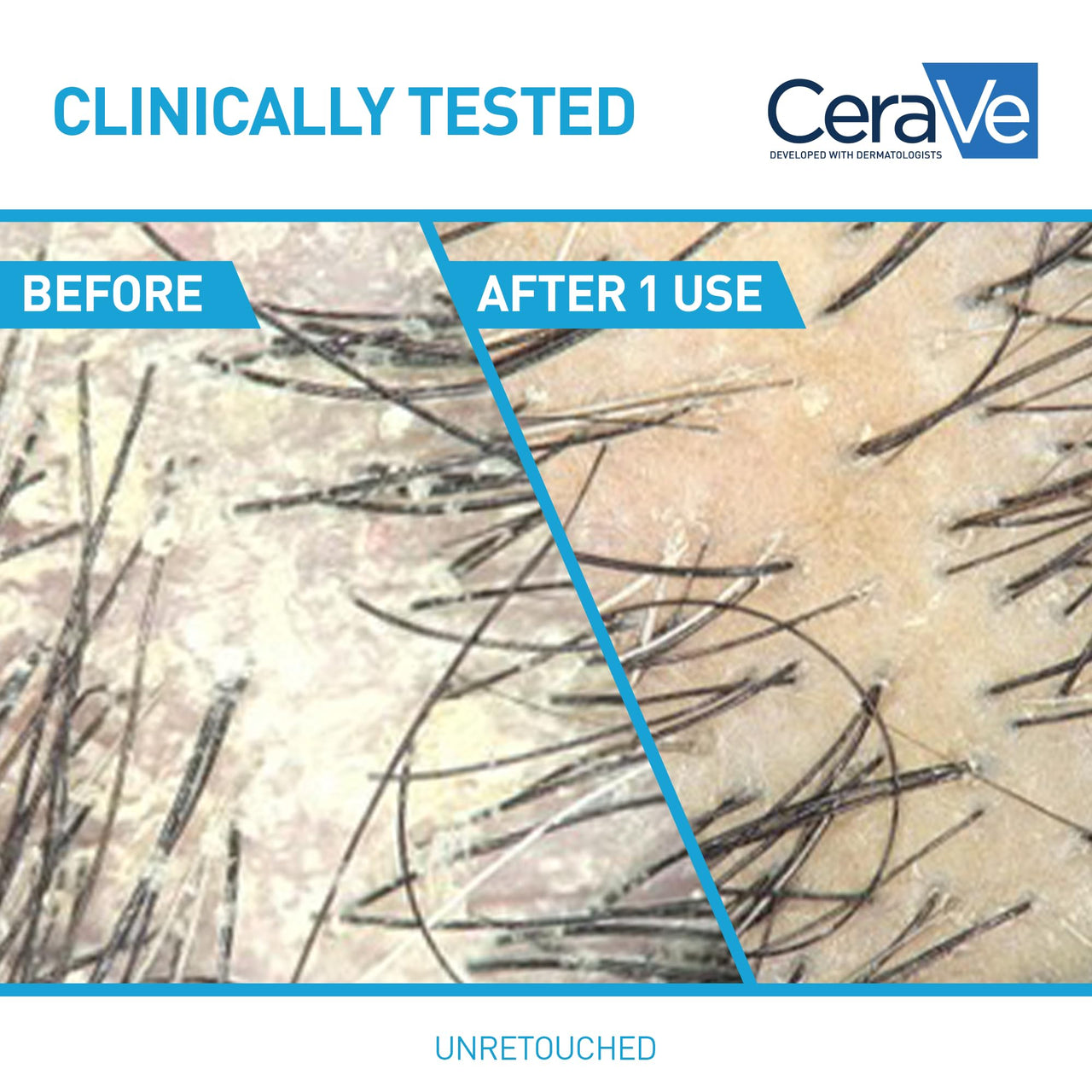 CeraVe Hydrating Anti Dandruff Shampoo, 1% Pyrithione Zinc Dandruff Treatment With Ceramides, Niacinamide & Hyaluronic Acid, Helps Eliminate Flakes & Provides Itchy Scalp Relief, Sulfate Free, 12 Oz