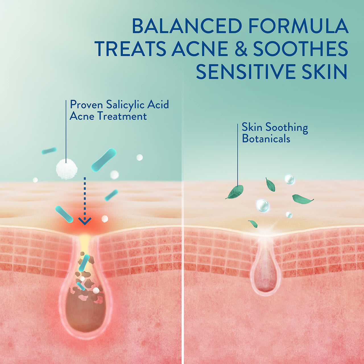 Cetaphil Acne Clearing Kit - Clarifying Acne Cream Cleanser (4.2 oz) & Mattifying Acne Moisturizer (3 oz) with Salicylic Acid, Deep Clean, Hydrate and Treat Sensitive Acne Prone Skin