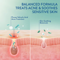 Thumbnail for Cetaphil Acne Clearing Kit - Clarifying Acne Cream Cleanser (4.2 oz) & Mattifying Acne Moisturizer (3 oz) with Salicylic Acid, Deep Clean, Hydrate and Treat Sensitive Acne Prone Skin