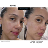 Thumbnail for EradiKate 3% Sulfur Daily Foaming Cleanser Acne Treatment – Clinically Formulated Medicated Face Wash Balances Skin and Cleans Pores, 4 Fl Oz