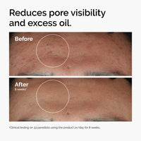 Thumbnail for The Ordinary Niacinamide 10% + Zinc 1%, Smoothing Serum for Blemish-Prone Skin, 1 Fl Oz