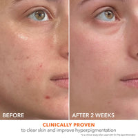 Thumbnail for Dr Dennis Gross Alpha Beta® 2% BHA+ Breakout Solution, Minimizes Pores, Clear & Prevent Breakouts, 5 Fl Oz