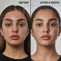 Thumbnail for The INKEY List SuperSolutions Benzoyl Peroxide 5% Face Wash, Non-Drying Cleanser with Glycerin & Hyaluronic Acid, Helps with Blemishes and Moisture, 5.07 fl oz
