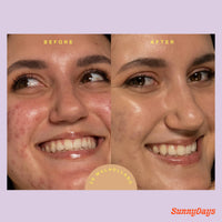 Thumbnail for Tower 28 SunnyDays SPF 30 Tinted Moisturizer - 2-in-1 Buildable Coverage Foundation + Mineral Sunscreen for Face - Zinc Oxide, Aloe & Prickly Pear for Sensitive Skin - 20 Light/Golden Neutral (1 oz)