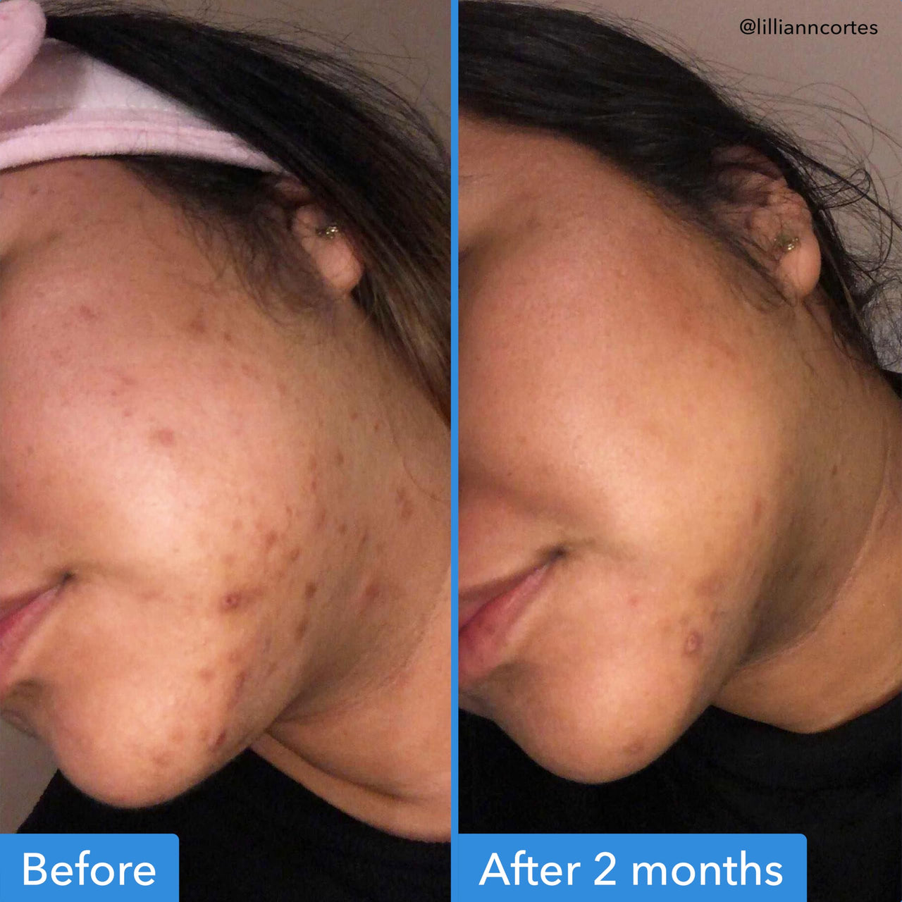 Good Molecules Discoloration Correcting Serum - Serum to Target Dark Spots and Hyperpigmentation - Skin Care for Face 1 FL