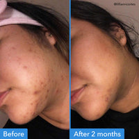 Thumbnail for Good Molecules Discoloration Correcting Serum - Serum to Target Dark Spots and Hyperpigmentation - Skin Care for Face 1 FL