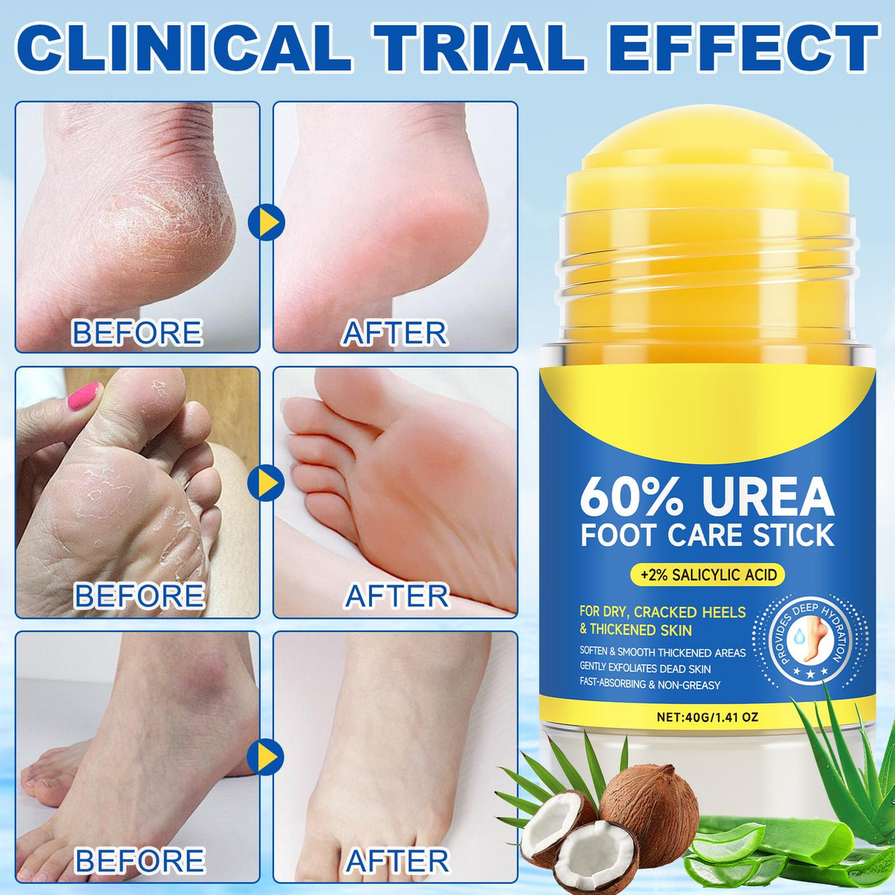Urea Cream Stick 60% Plus 2% Salicylic Acid, Extra Strength Urea Foot Cream for Dry Cracked Heels, Callus Remover for Feet,Moisturizing Lotion for Hands, Knees,Elbows,Softens and Exfoliates Dead Skin