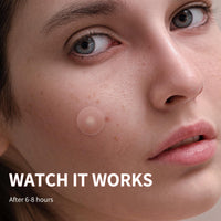 Thumbnail for Daolyo Pimple Patches for Face, 4 Size 300 Counts Acne Patches, Hydrocolloid Patches for Covering Zits and Blemishes, Spot Stickers with Salicylic Acid, Tea Tree Oil & Calendula Oil