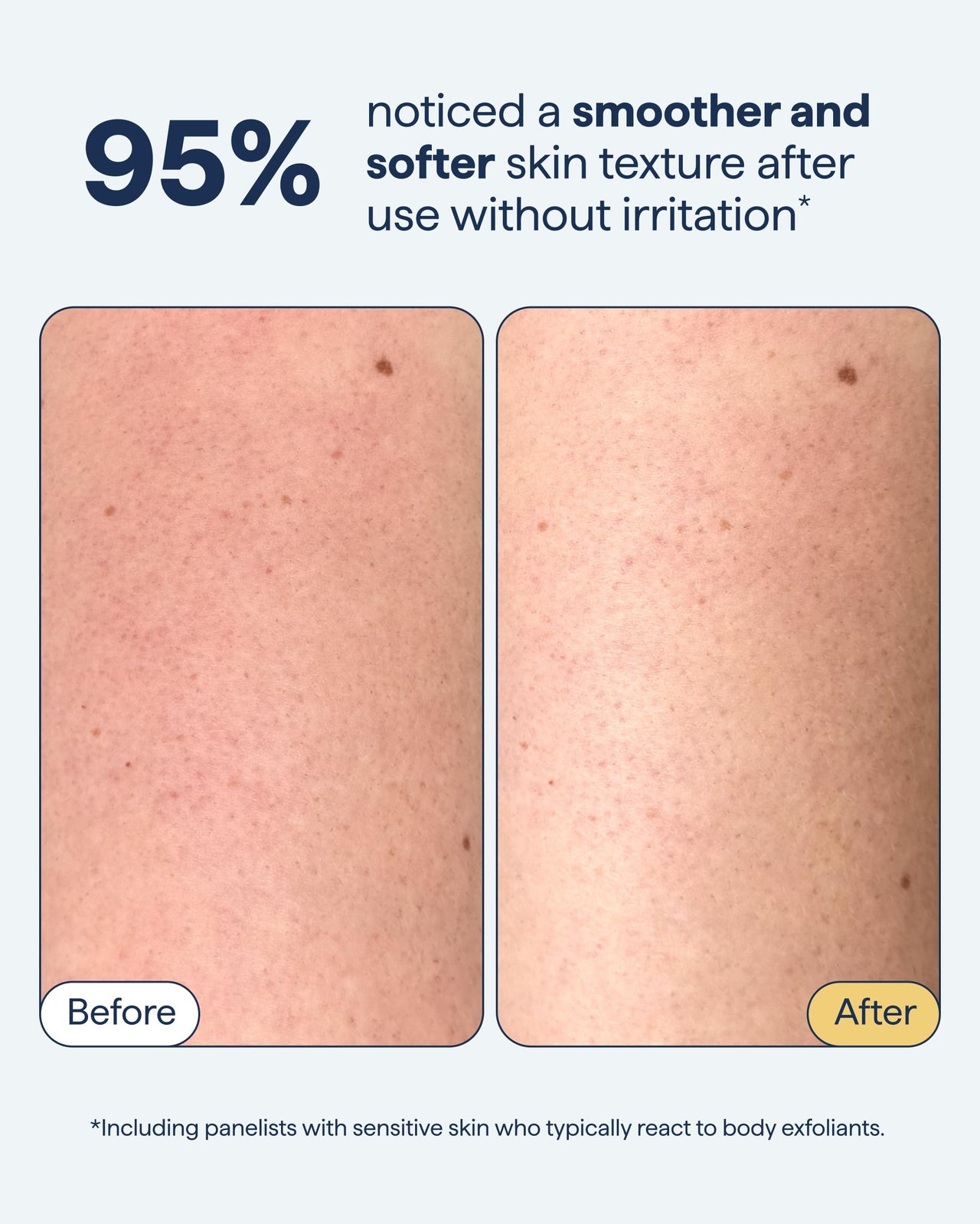 Remedy KP Exfoliating Body Scrub | Keratosis Pilaris and Chicken Skin Treatment with Fine Sugar, Glycolic Acid, Lactic Acid and Squalane | Exfoliating Scrub | By Dermatologist Dr. Shah, 6.8 fl oz