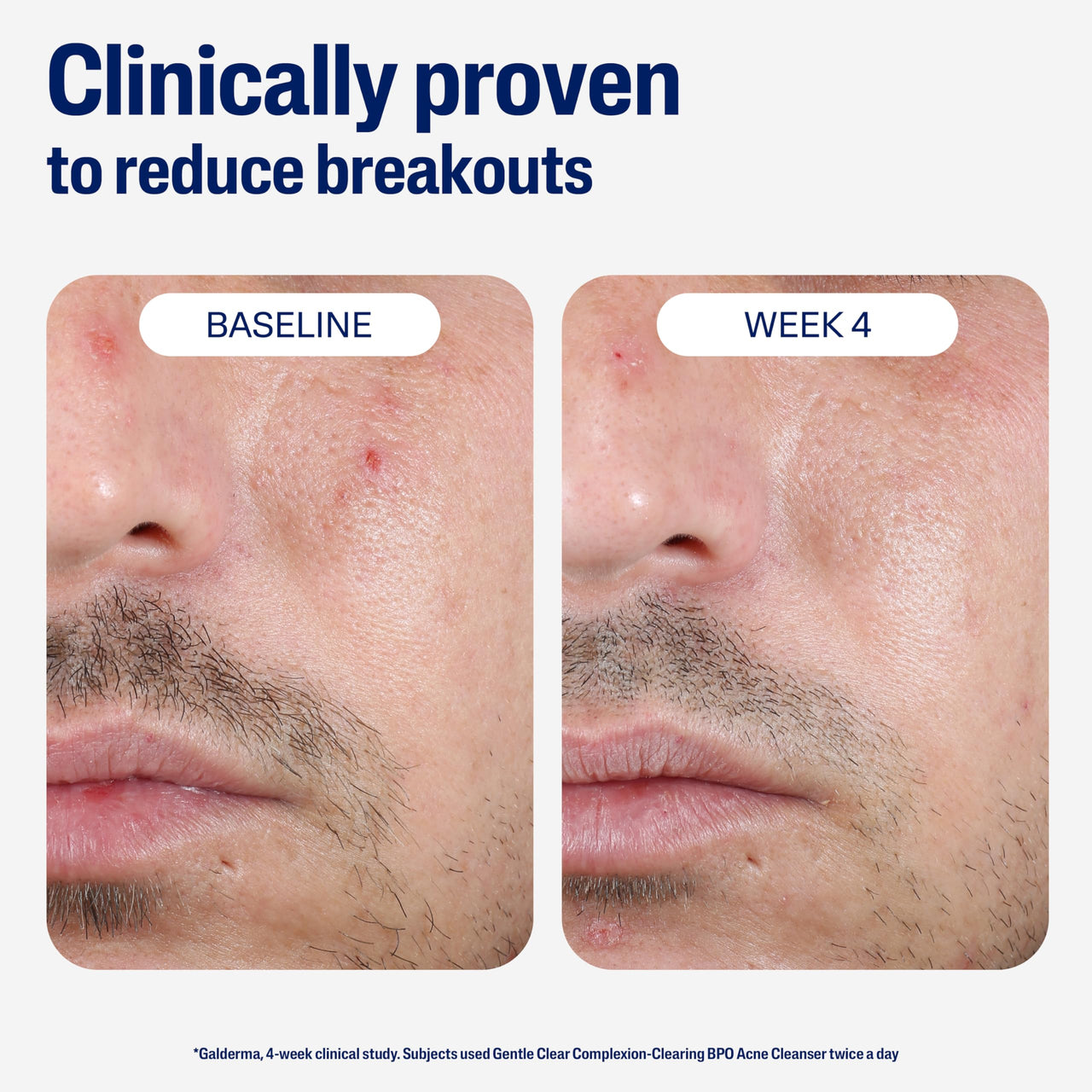 Cetaphil Gentle Clear Complexion-Clearing BPO Acne Cleanser with 2.6% Benzoyl Peroxide, Creamy and Soothing for Sensitive Skin, Suitable for All Skin Types, 4.2oz