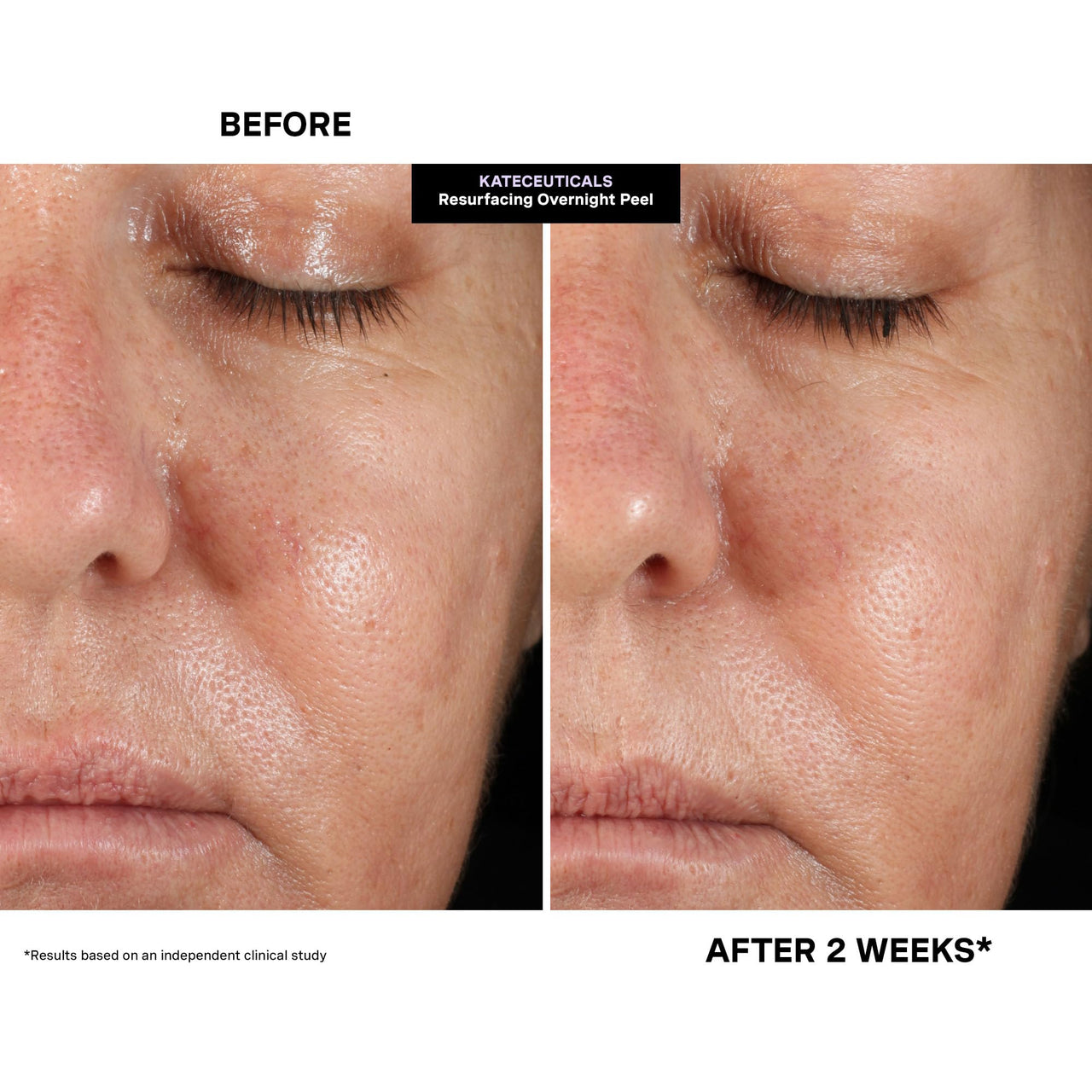 Kate Somerville KateCeuticals Resurfacing Overnight Peel | Clinic-Grade Face Peel | Powerful Anti-Aging Treatment | 1 Fl Oz