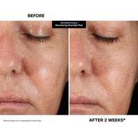 Thumbnail for Kate Somerville KateCeuticals Resurfacing Overnight Peel | Clinic-Grade Face Peel | Powerful Anti-Aging Treatment | 1 Fl Oz