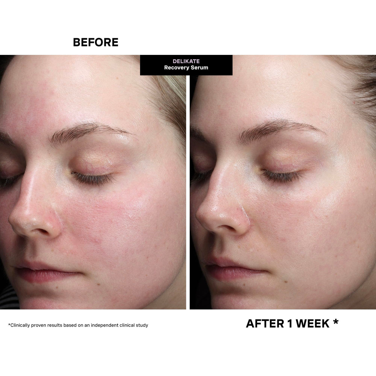 Kate Somerville DeliKate Recovery Serum – Clinically Formulated Hydrating Treatment – Irritation and Redness Relief for Stressed or Sensitive Skin, 1 Fl Oz