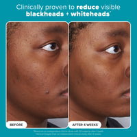 Thumbnail for Paulas Choice--SKIN PERFECTING 2% BHA Liquid Salicylic Acid Exfoliant--Facial Exfoliant for Blackheads, Enlarged Pores, Wrinkles & Fine Lines, 4 oz Bottle