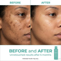 Thumbnail for Urban Skin Rx® Witch Hazel Brightening & pH Balancing Toner, Exfoliated & Clarifies Clogged Pores, Improves The Appearance of Uneven Skin Tone, Reduces Redness & Brightens Dull Complexions, 4.5 Fl Oz