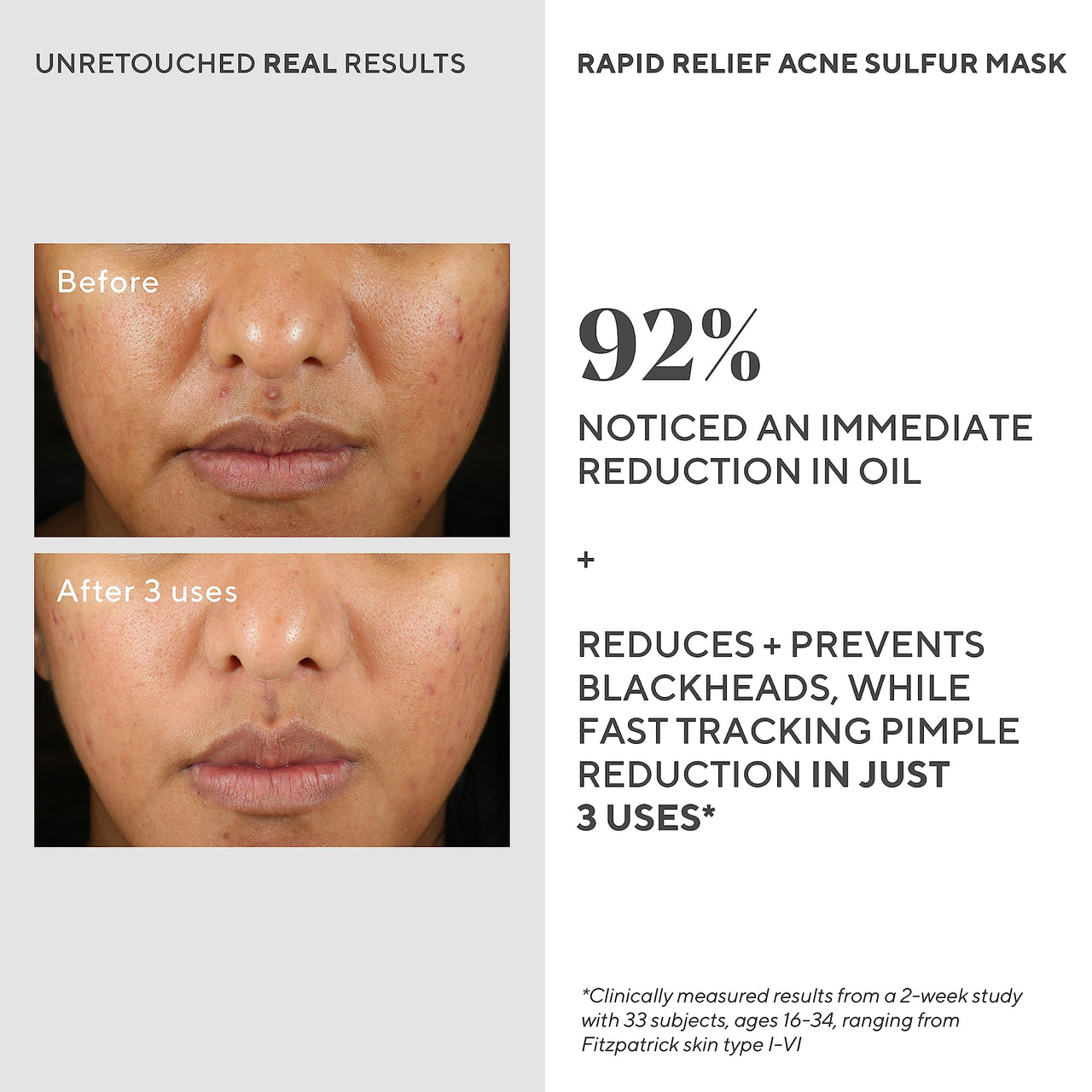 Murad Rapid Relief Acne Sulfur Mask - Acne Control Clay Face Mask with Salicylic Acid - 2.5 fl oz