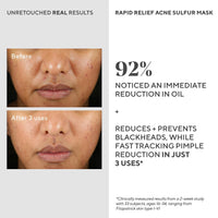 Thumbnail for Murad Rapid Relief Acne Sulfur Mask – Clay Mask with Salicylic Acid, 5% Sulfur, and Austrian Peat Reduces Oil, Minimizes Breakouts, Reduces Pimple Size, and Unclogs Pores – 2.5 Fl Oz