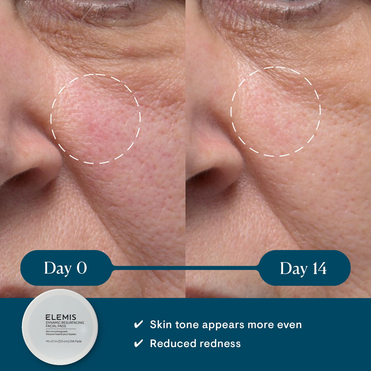 ELEMIS Dynamic Resurfacing Facial Pads 14pk, Trial Size Textured Exfoliating Pads for Radiant Complexion