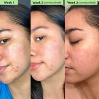 Thumbnail for Sand & Sky Oil Control Blemish Clearing Clay Face Mask with Salicylic Acid & Niacinamide - Blemish Fighting Mask, Minimizes Redness, Tightens Pores