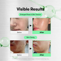 Thumbnail for VT COSMETICS CICA Reedle Shot 700, Spicule Microneedling Serum for Pore Care&Exfoliation, Exosome&Centella Asiatica for Glass Skin, Acne&Blemish Care, Korean Liquid Skin Booster (1 Fl Oz / 30ml)