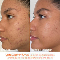 Thumbnail for Dr. Dennis Gross Alpha Beta Extra Strength Daily Peel: for Oily Skin, Uneven Tone or Texture, Wrinkles or Enlarged Pores (30 Treatments)