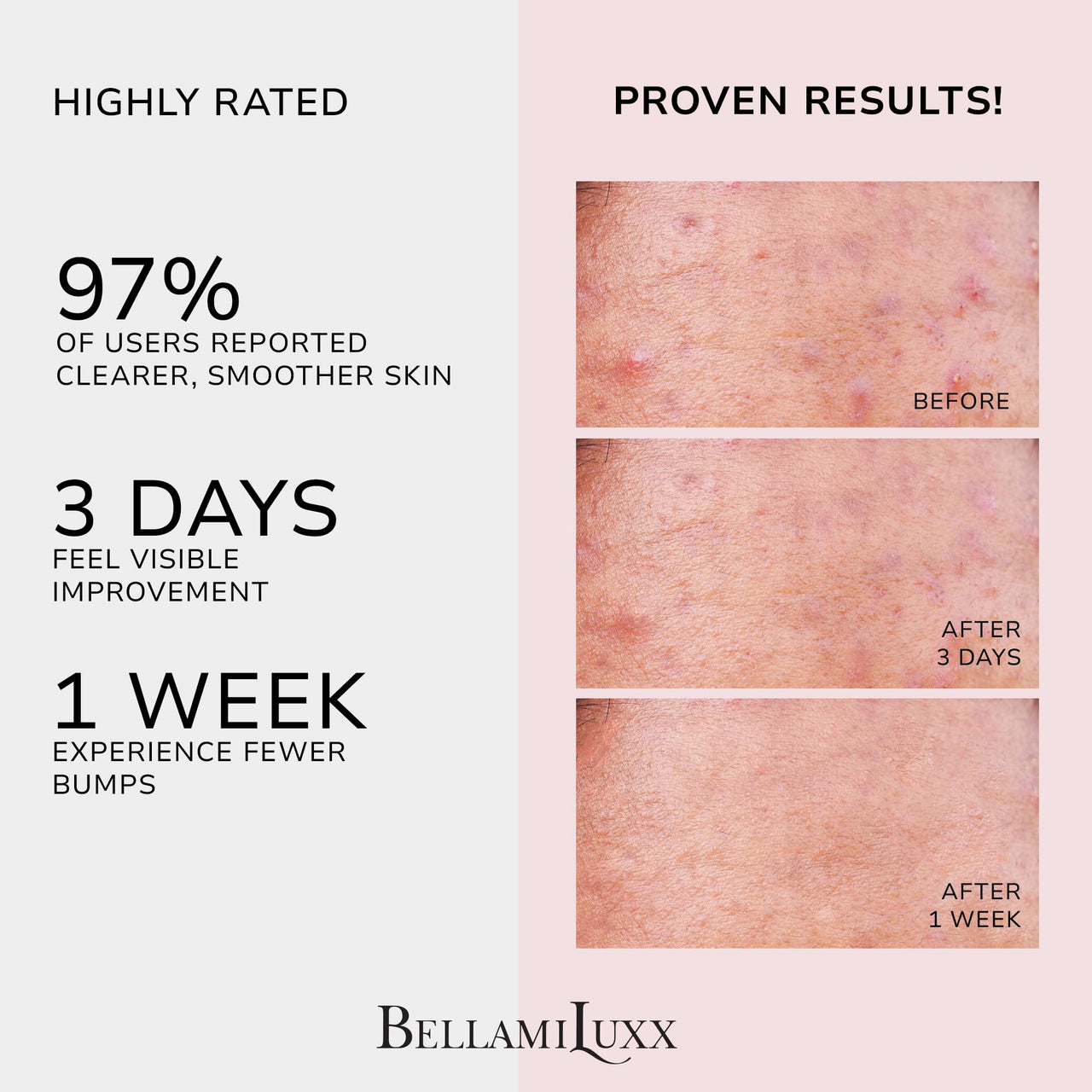 BellamiLuxx Butt Acne Clearing Treatment Cream: Body Acne Treatment for Folliculitis and Pimples on Buttocks, Thighs, and Body with 2% Salicylic Acid & Tea Tree Oil - Butt Cream for Smooth Skin