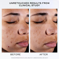 Thumbnail for Lancôme Clarifique Pro-Solution Face Serum - Facial Serum For Visibly Reducing Dark Spots & Acne Spots - With 10% PHA and Niacinamide - 1.0 Fl Oz