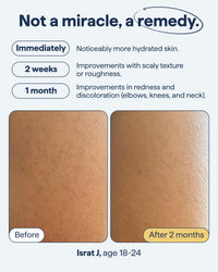 Thumbnail for Remedy KP Body Moisturizer | Keratosis Pilaris and Chicken Skin Treatment with Retinol, Urea, Lactic Acid and Ceramides | Exfoliating and Moisturizing Lotion | By Dermatologist Dr. Shah, 7.7 fl oz