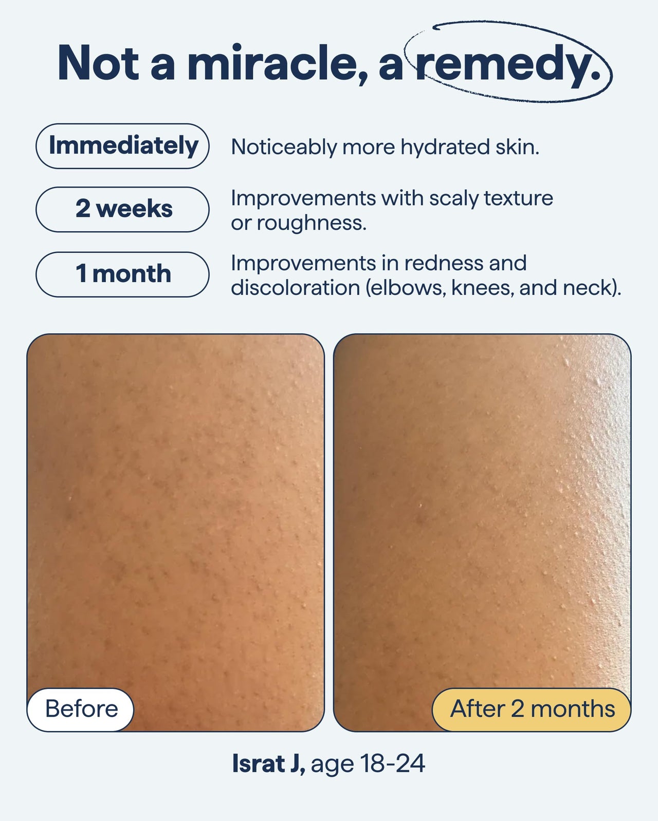 Remedy KP Duo Exfoliating Body Scrub and Moisturizer for Smoother Skin | Keratosis Pilaris and Chicken Skin | Glycolic Acid, Retinol, Urea, Ceramides | By Dermatologist Dr. Shah | 6.8 + 7.7 fl oz