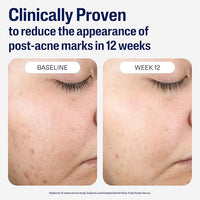 Thumbnail for Image 5 of Cetaphil Gentle Clear Post-Acne Skin Serum, Bakuchiol Retinol Alt, 1oz