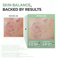 Thumbnail for Image 5 of SKIN1004 Azelaic Acid 10% Ampoule, Korean Facial Centella Serum,1.01 fl.oz