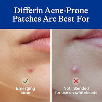 Thumbnail for Image 4 of Differin Acne Treatment Pimple Patches, Salicylic Acid & Centella, 36ct