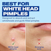Thumbnail for Image 3 of Differin Power Pimple Patches, Hydrocolloid Acne Treatment, 23ct