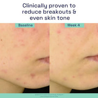 Thumbnail for Image 6 of Cetaphil Gentle Clear Acne Serum Salicylic Acid Treatment, 1oz