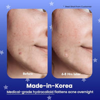 Thumbnail for Image 4 of AVARELLE Spot Pimple Patches for Face
