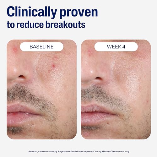 Image 6 of Cetaphil Gentle Clear BPO Acne Face Wash, Soothing, Sensitive Skin, 4.2oz