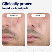 Thumbnail for Image 6 of Cetaphil Gentle Clear BPO Acne Face Wash, Soothing, Sensitive Skin, 4.2oz