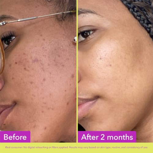 Image 8 of Good Molecules 10% Azelaic Acid Treatment for Face